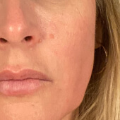 Before Pureance: Uneven skin tone and texture around the mouth