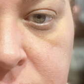 Before Pureance: Eye puffiness and dark circles visible